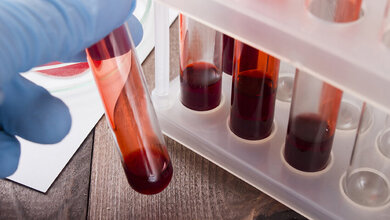 Bluttest.jpg Flüssigbiopsien als Alternative