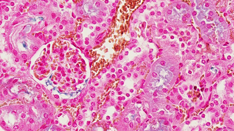 Giftiges Eisen in Organen 