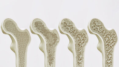 Osteoporose