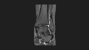 Titelbild des Fachbeitrags zur Bildgebung bei skelettalen Veränderungen: Talokalkaneare Koalition