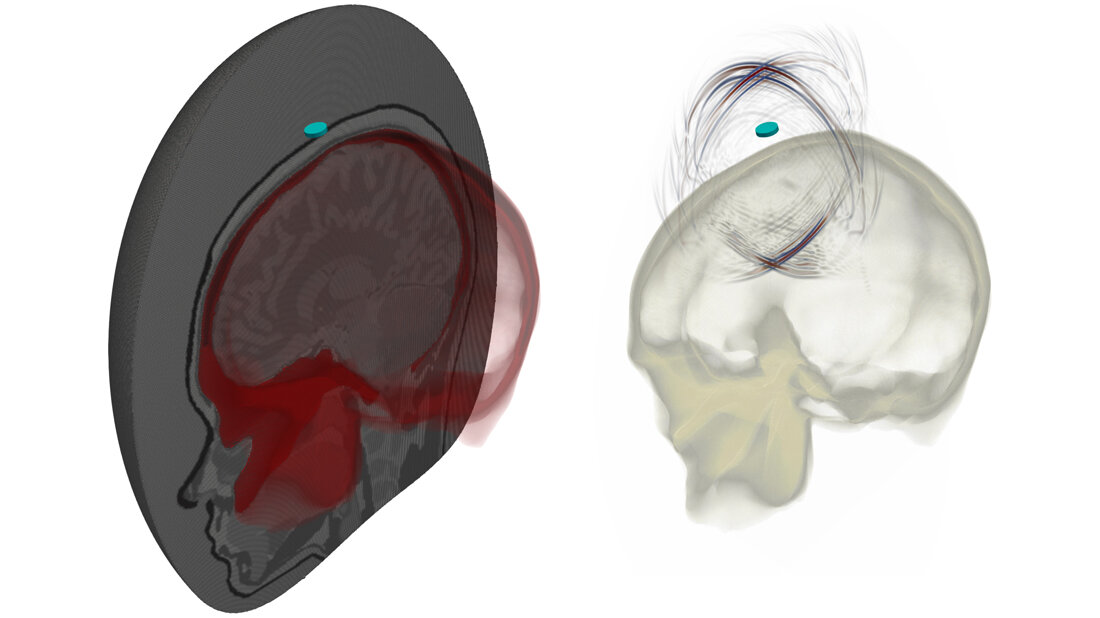 Ultraschall.jpg Ultraschall für das Gehirn nutzen?