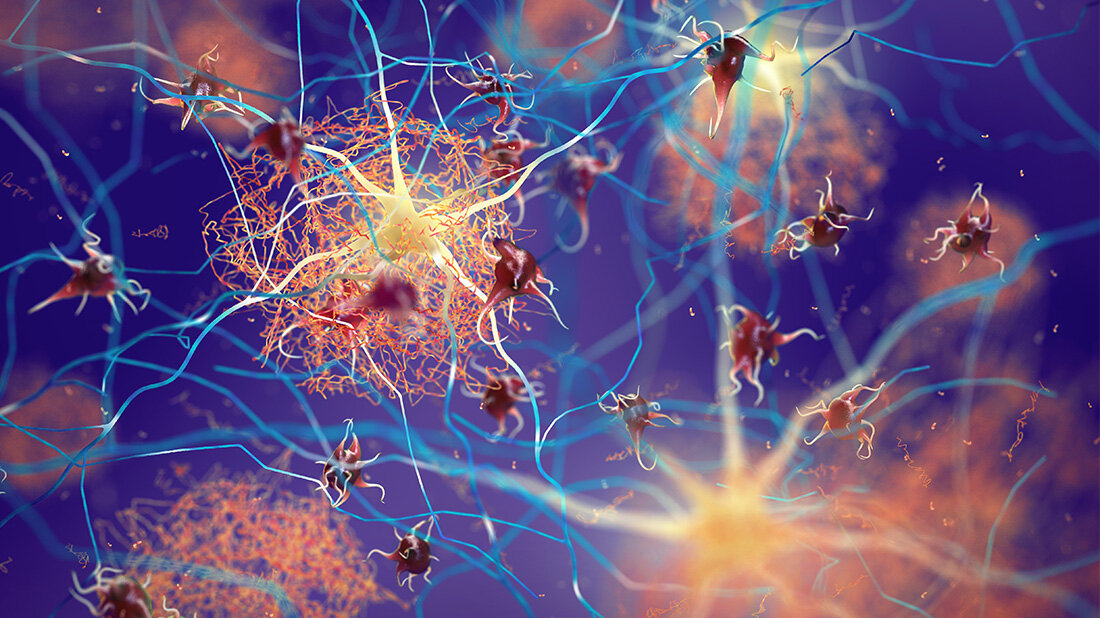 Neues Alzheimermedikament kurz vor der Zulassung