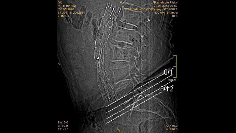 Schnittbilddiagnostik der Wirbelsäule (7.17)