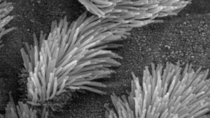 Mukoviszidose (Teil 2)