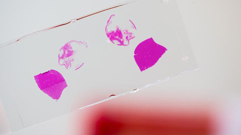 Akute myeloische Leukämie