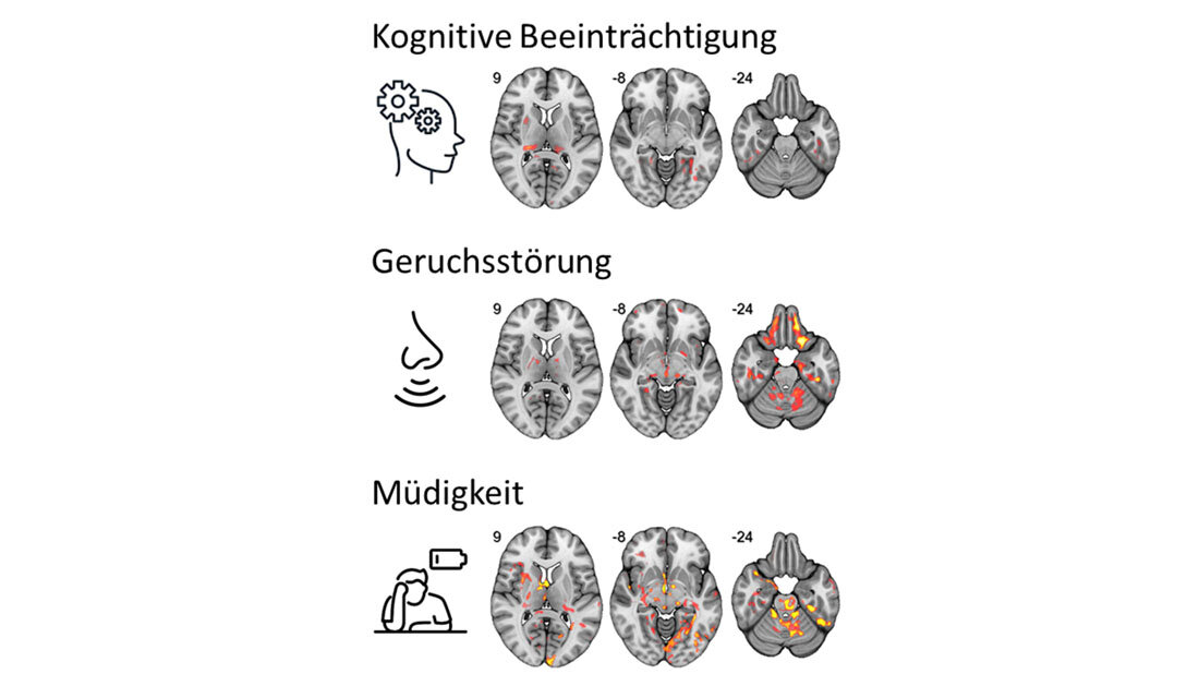 Post_COVID_Gehirn.jpg Zusammenhang zwischen einer veränderten Mikrostruktur in spezifischen Netzwerken des Gehirns mit kognitiven Beeinträchtigungen, Geruchsverlust und Fatigue.