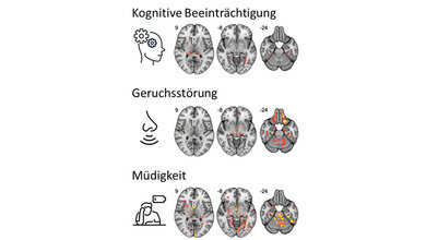 Post_COVID_Gehirn.jpg Zusammenhang zwischen einer veränderten Mikrostruktur in spezifischen Netzwerken des Gehirns mit kognitiven Beeinträchtigungen, Geruchsverlust und Fatigue.