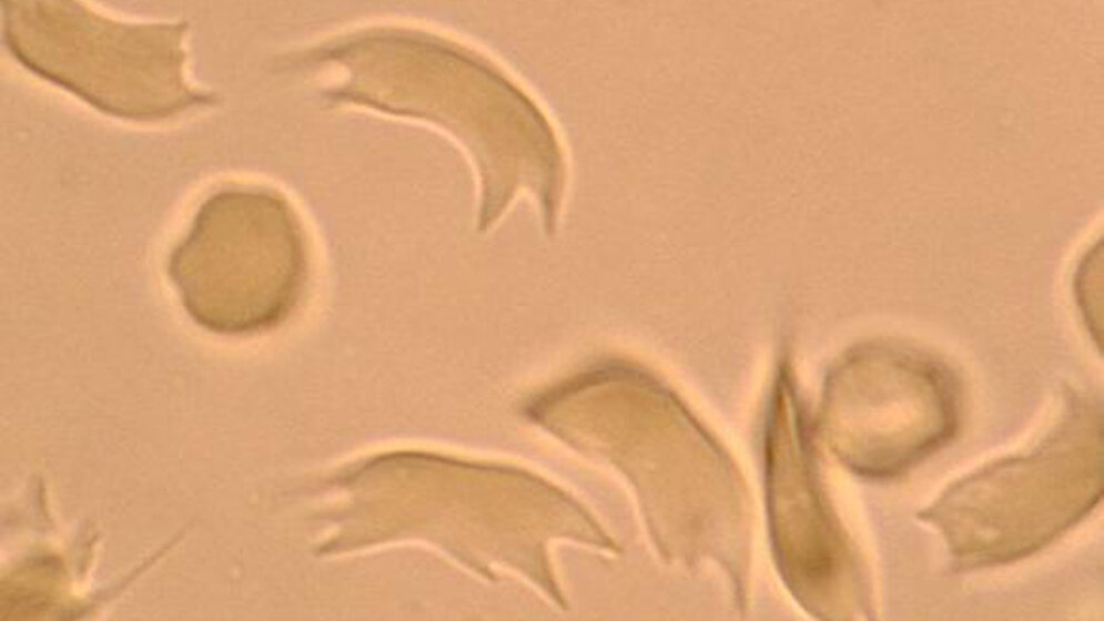 Sichelzellen nach O2-Entzug mittels Sichelzelltest