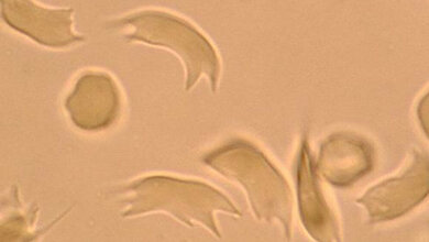 Sichelzellen nach O2-Entzug mittels Sichelzelltest