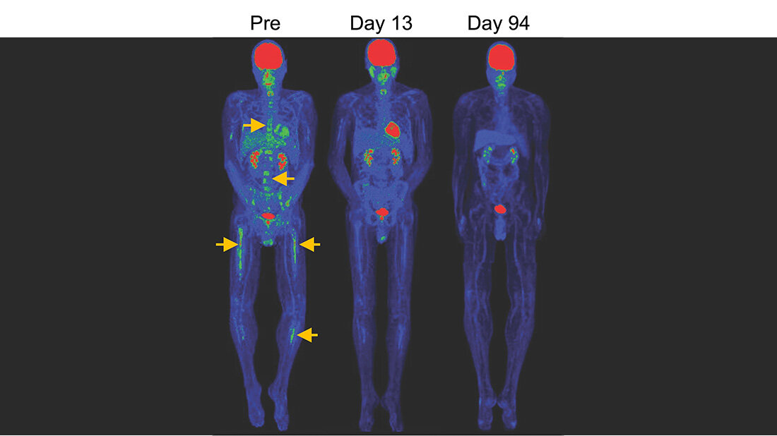Vergleich von drei Ganzkörper-Scans an verschiedenen Tagen (Pre, Day 13, Day 94) mit farblich markierten Bereichen zur Darstellung von Veränderungen im Körper