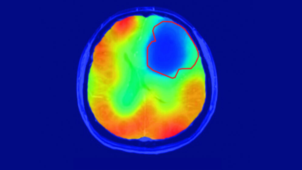 Die_rote_Linie_markiert_das_Tumorareal_Paech_Radiology.jpg Die rote Linie markiert das Tumorareal