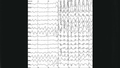 Für eine AbsenceEpilepsie typisches Anfallsmuster