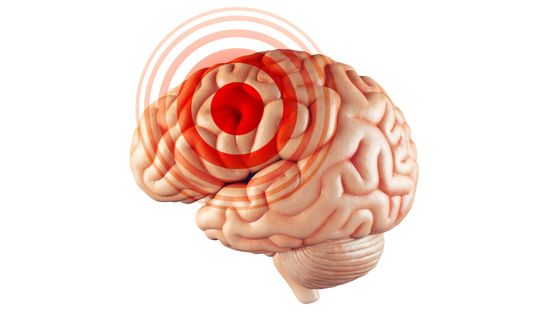 Symbolbild für Hirntumor