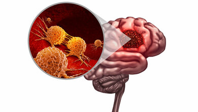 Neue Studie zur Bekämpfung des Glioblastoms