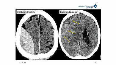 Titelbild zum Beitrag über Diagnose und Therapie bei Hirnblutungen