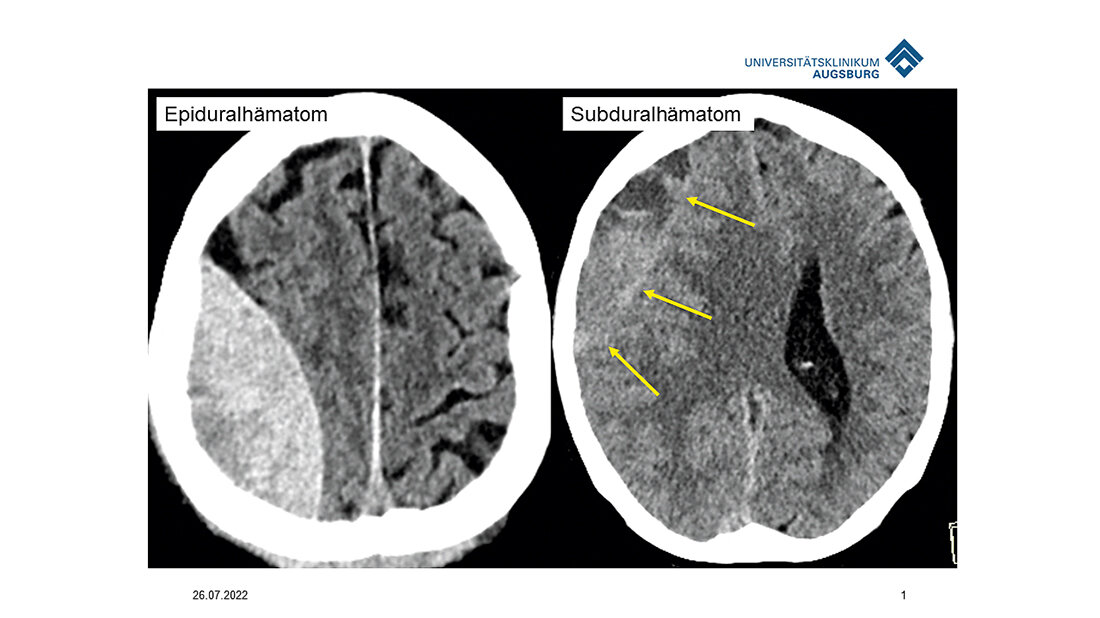 Titelbild zum Beitrag über Diagnose und Therapie bei Hirnblutungen