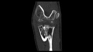 Titelbild zum Fachbeitrag über die kongenitale proximale radioulnare Synostose mit Morbus Hegemann