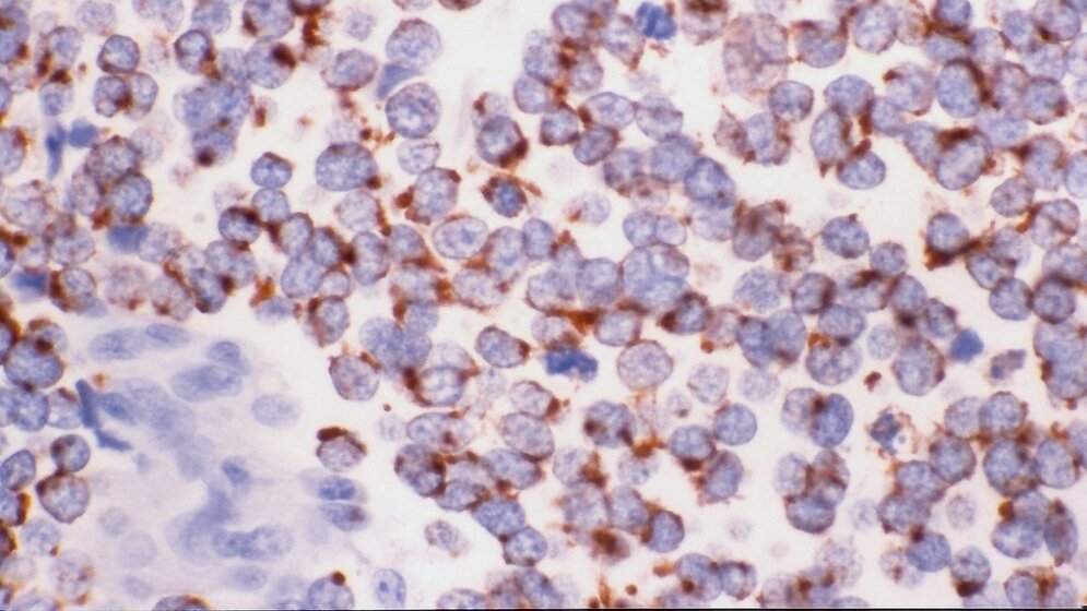 Kleinzelliger Lungenkrebs