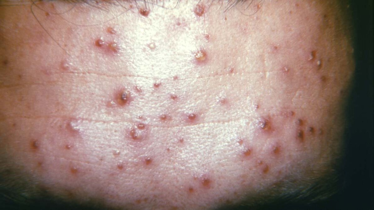 Makulopapulöser Ausschlag bei Windpocken