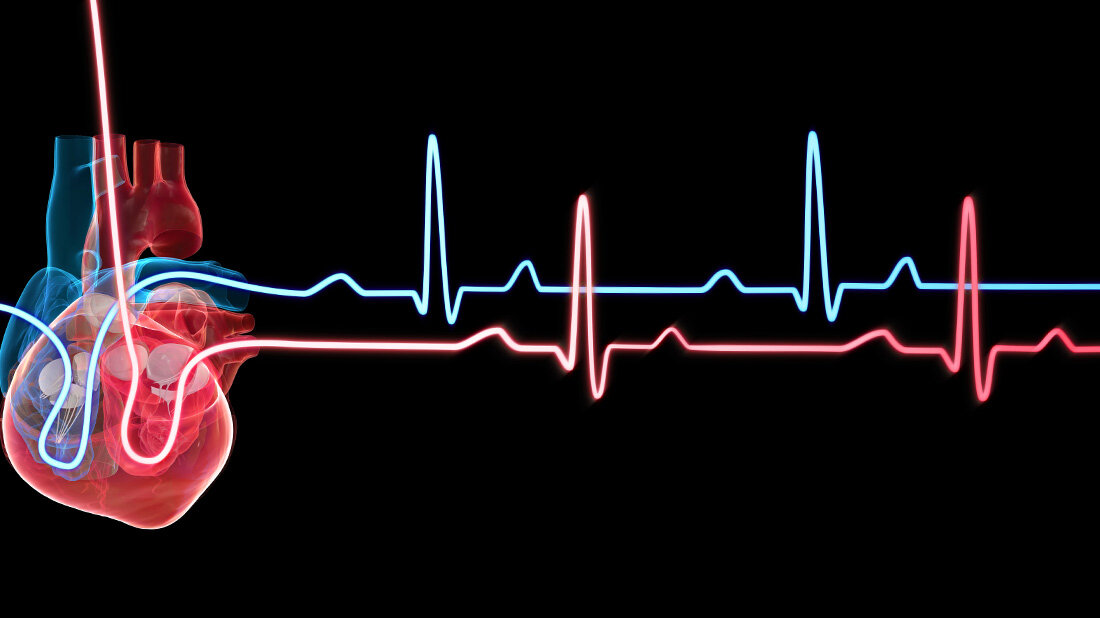 EKG_Herzschlagdiagramm.jpg Lässt sich Vorhofflimmern bald gezielt medikamentös behandeln?