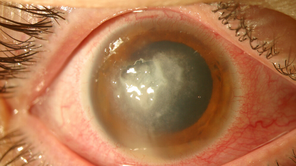 Keratitis_durch_Schimmelpilze_bei_Kontaktlinsentraeger_Dr_Mathias_Roth_Prof_Dr_Gerd_Geerling_Klinik_fuer_Augenheilkunde_Universitaetsklinikum_Duesseldorf.jpg Keratitis durch Schimmelpilze
