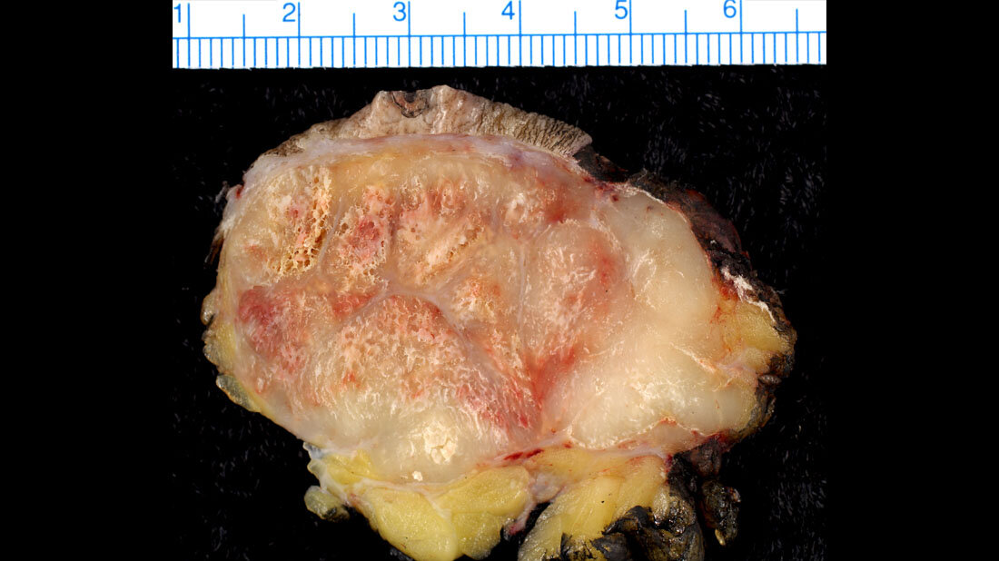 Makropathologischer Befund eines Merkelzellkarzinoms 