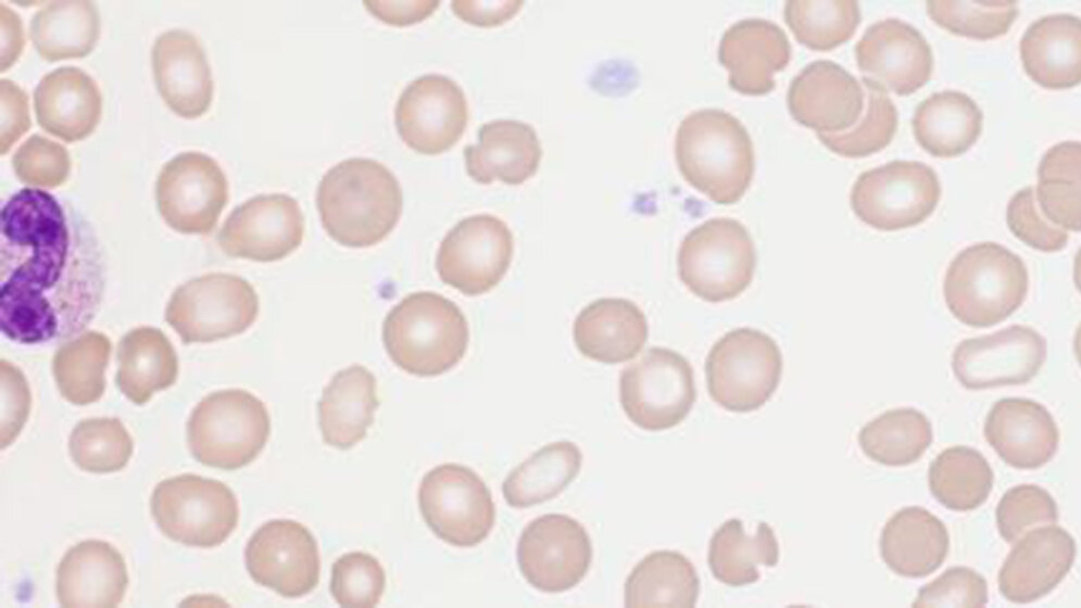 Pilzförmige Erythrozyten