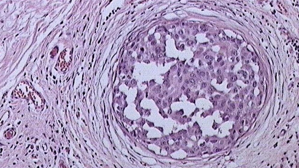 DCIS__Itayba_CC_BY_SA_3_0_22042016.jpg DCIS