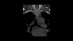 Anomalien und Normvarianten: Skelettale Veränderungen 3.16