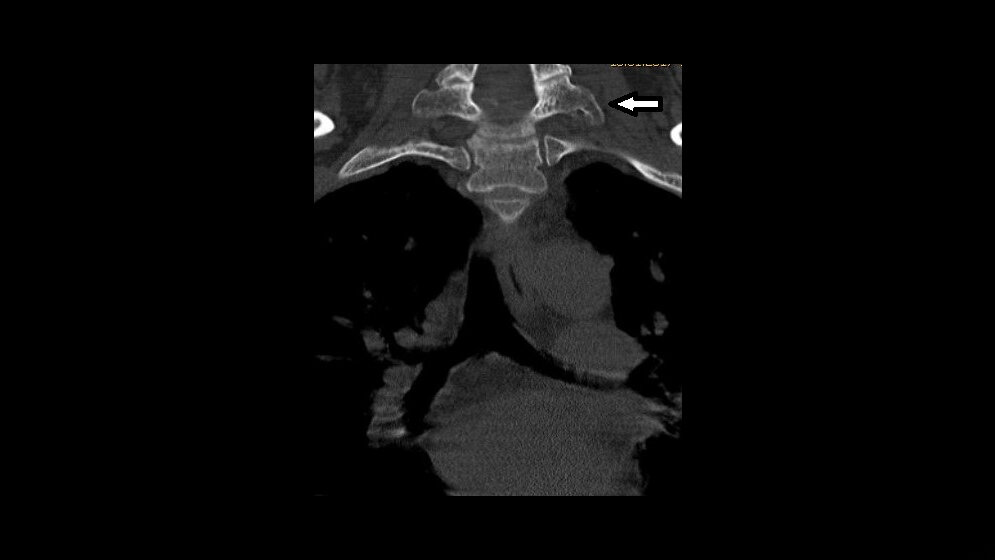Anomalien und Normvarianten: Skelettale Veränderungen 3.16