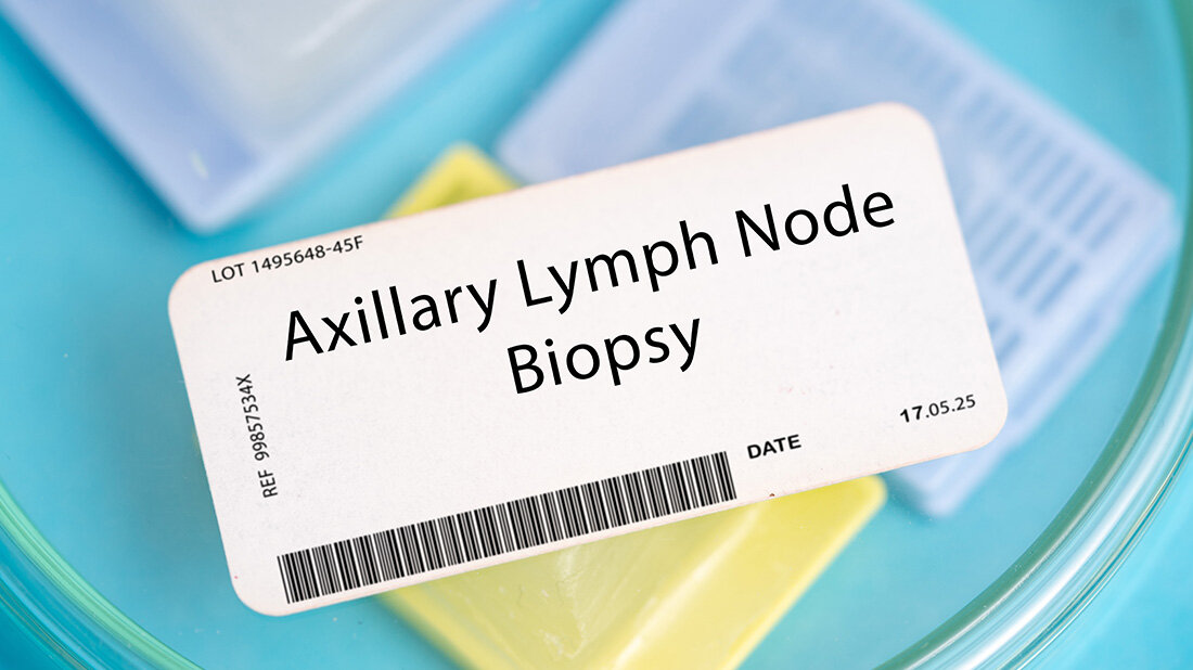 Brustkrebs_Fruehstadium.jpg Axilläres Lymphknotenmanagement bei Brustkrebs im Frühstadium