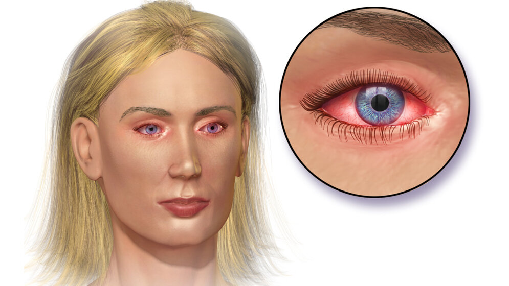 Konjunktivitis_Blausen.jpg Konjunktivitis