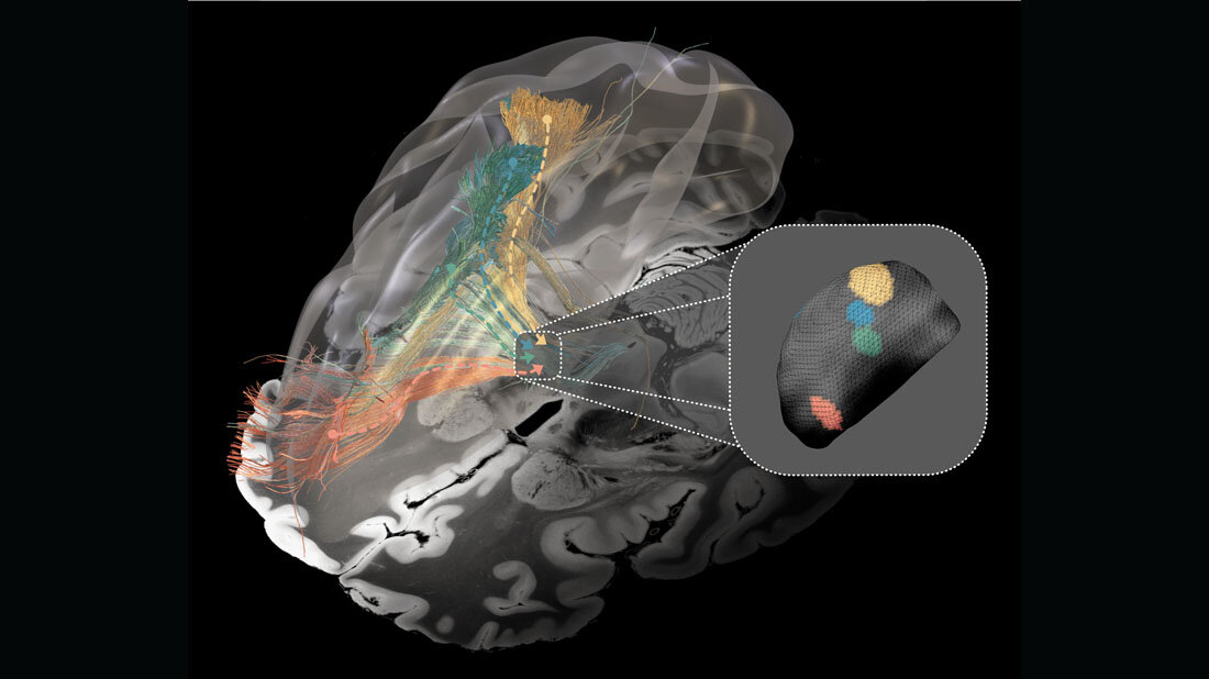 Betroffene Nervenbündel bei Parkinson-Syndrom (grün), Dystonie (gelb), Tourette-Syndrom (blau) und Zwangsstörung (rot).