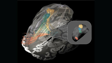 Betroffene Nervenbündel bei Parkinson-Syndrom (grün), Dystonie (gelb), Tourette-Syndrom (blau) und Zwangsstörung (rot).