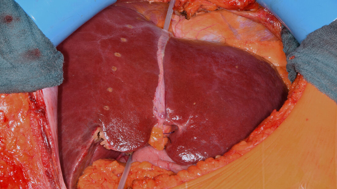 Teilorganspende der Leber