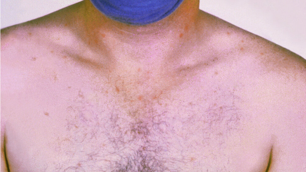 75 Ausbrüche von Typhus