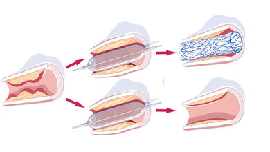 Stent