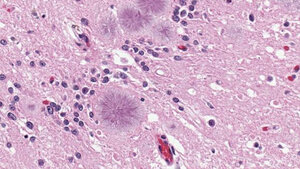 Creutzfeldt-Jakob-Krankheit