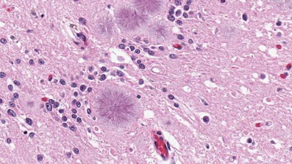 Creutzfeldt-Jakob-Krankheit