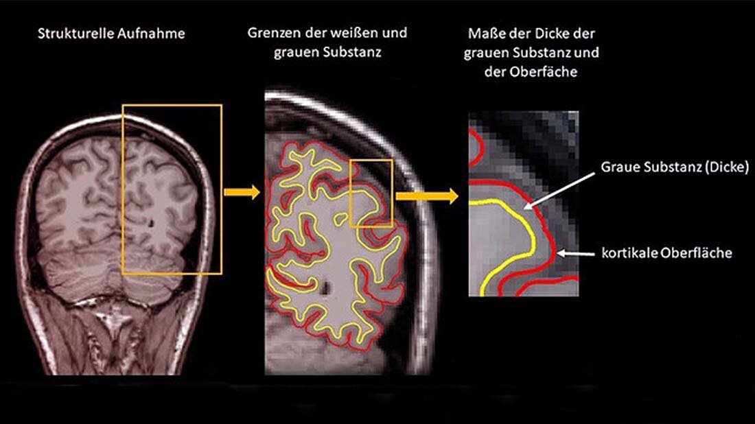 Gehinr_Veraenderungen.jpg Die Studie zeigt, dass frühkindliche Erfahrungen die Hirnstruktur langanhaltend und offenbar nicht reversibel verändern können.