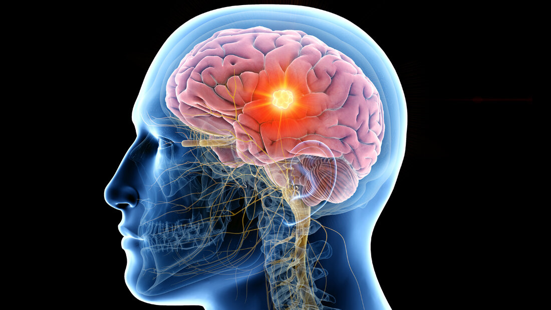 Hirnmetastasen bestrahlen