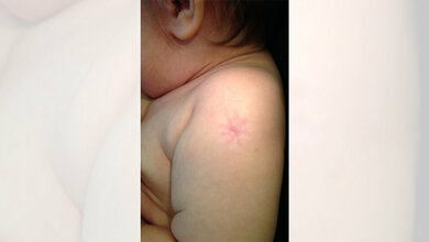 Narbe durch BCG-Impfstoff