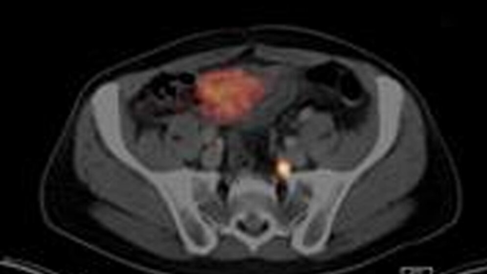 Radioliganden-Nuklearmedizin-TUM.jpg Prostatakrebs
