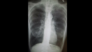 Patient mit COPD