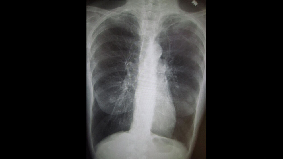 COPD_Bild.jpg COPD