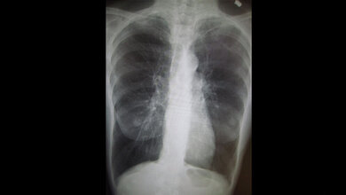 COPD_Bild.jpg schwere COPD