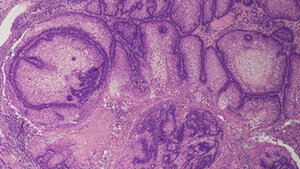 Adenoma sebaceum