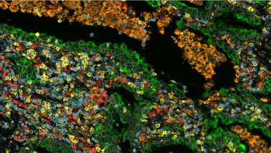NSCLC.jpg Darstellung mithilfe von Multiplex Immunhistochemie