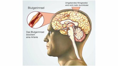 Neue Entdeckungen könnten die derzeitige Schlaganfalltherapie revolutionieren