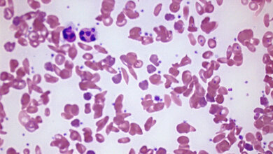 Blutausstrich bei Sichelzellenanämie